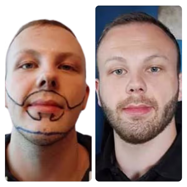 Beard Transplant in Turkey